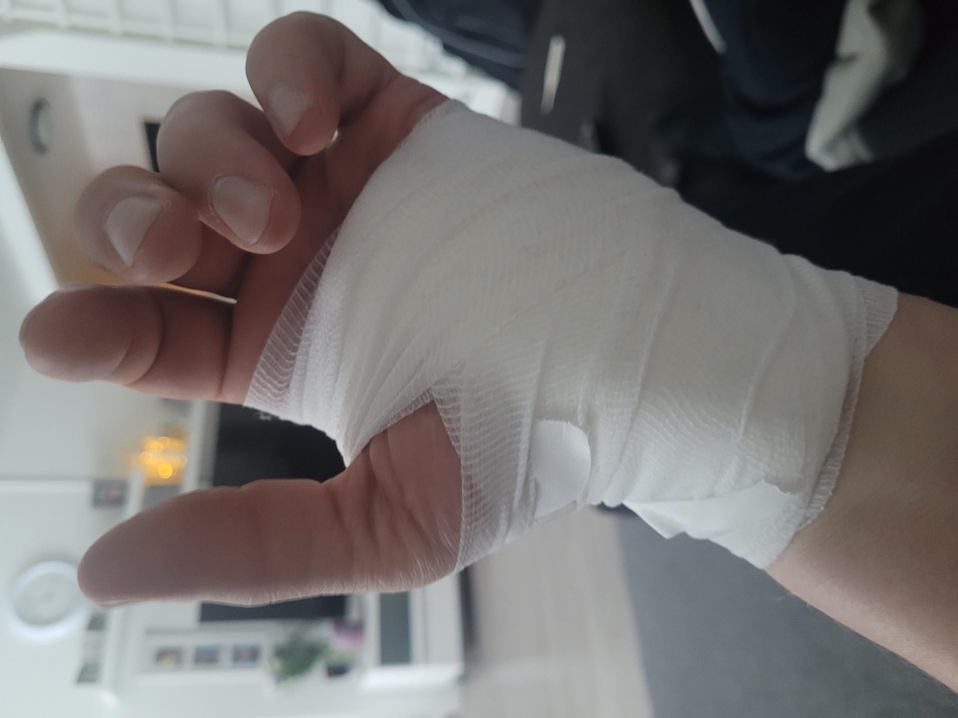 Henkilökohtainen kuntoutustarina rannekanavaleikkauksesta